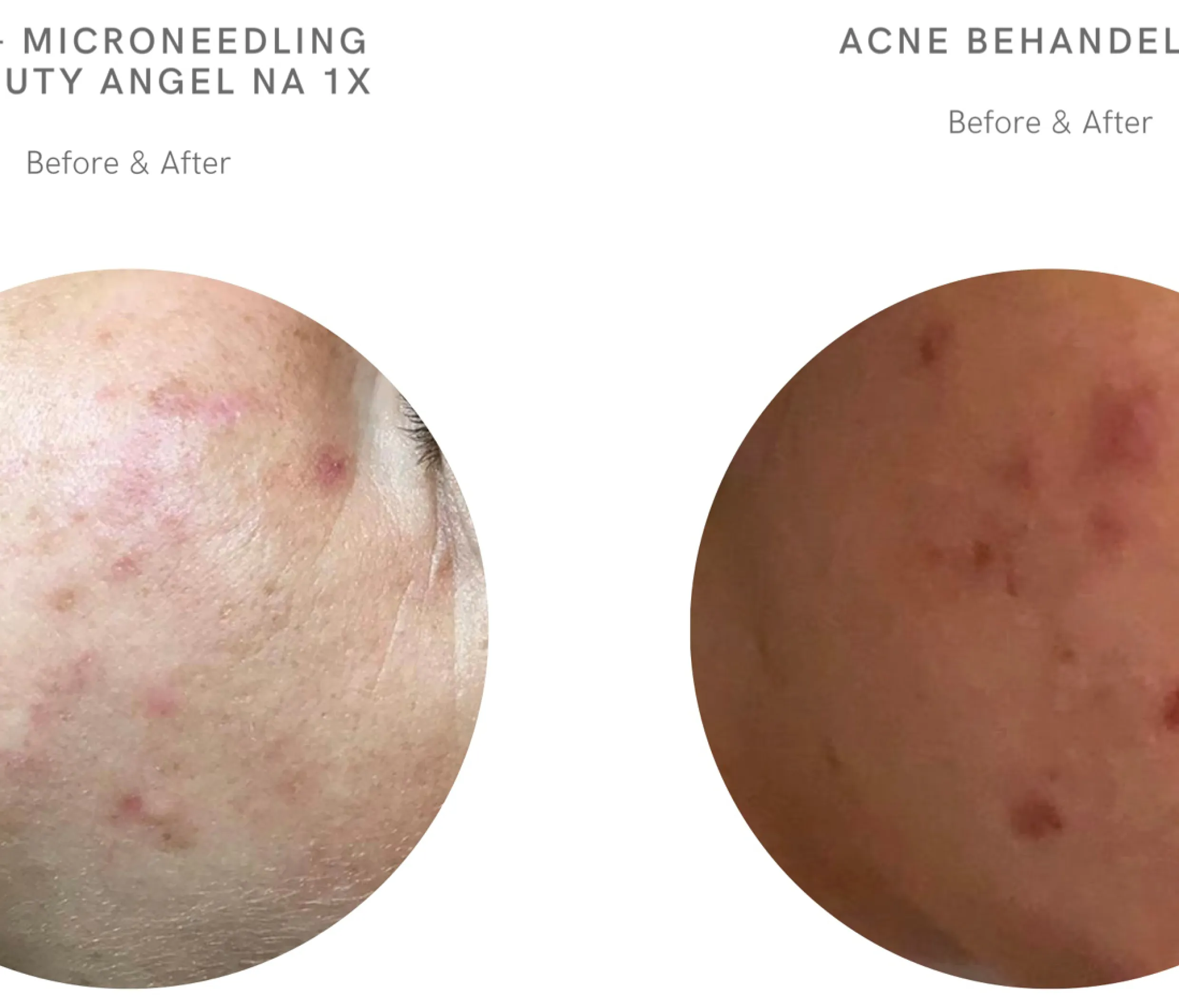 Acnebehandeling, resultaat voor en na, bij Richmond Skin Clinic in Wassenaar