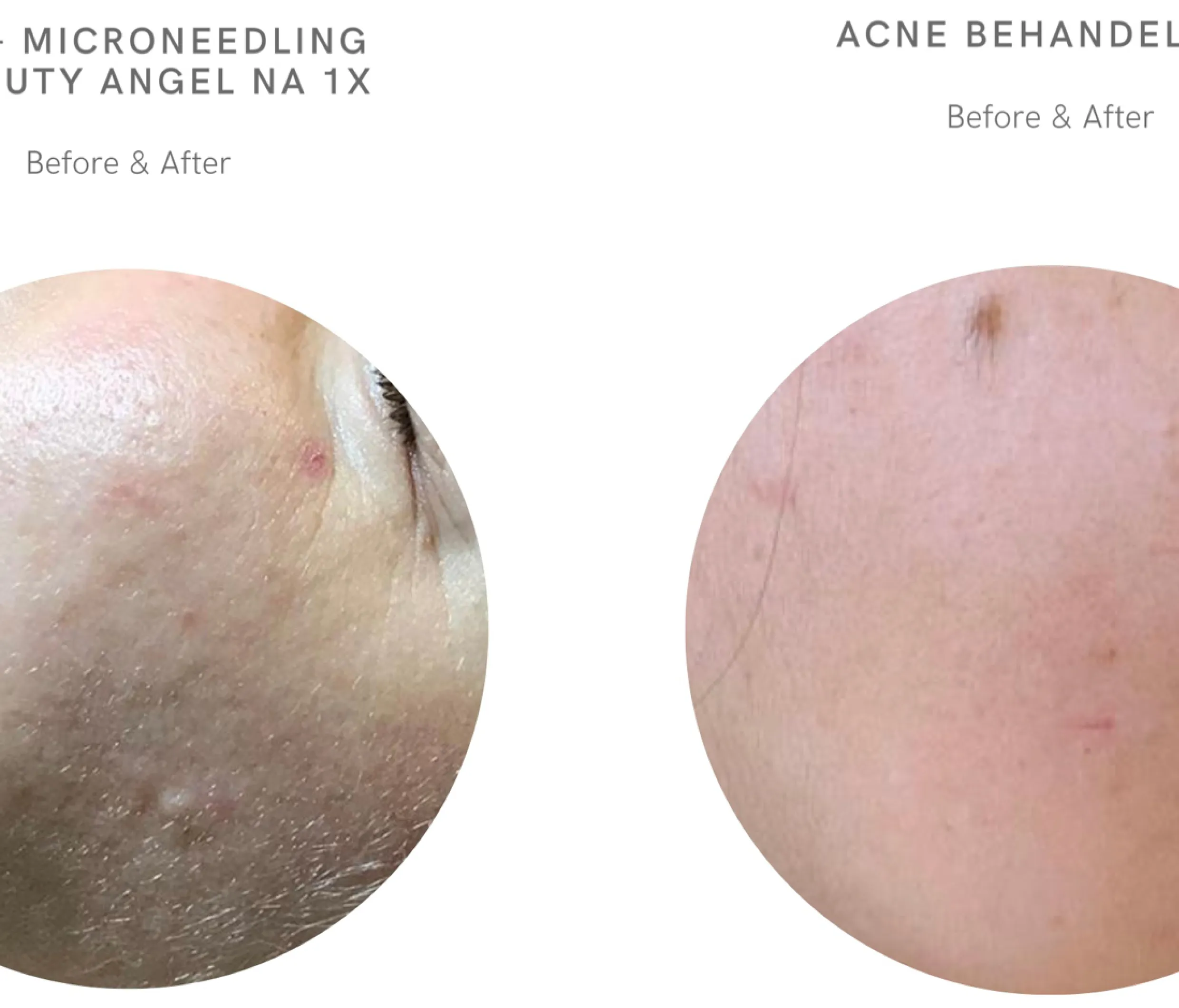 Acnebehandeling, resultaat voor en na, bij Richmond Skin Clinic in Wassenaar