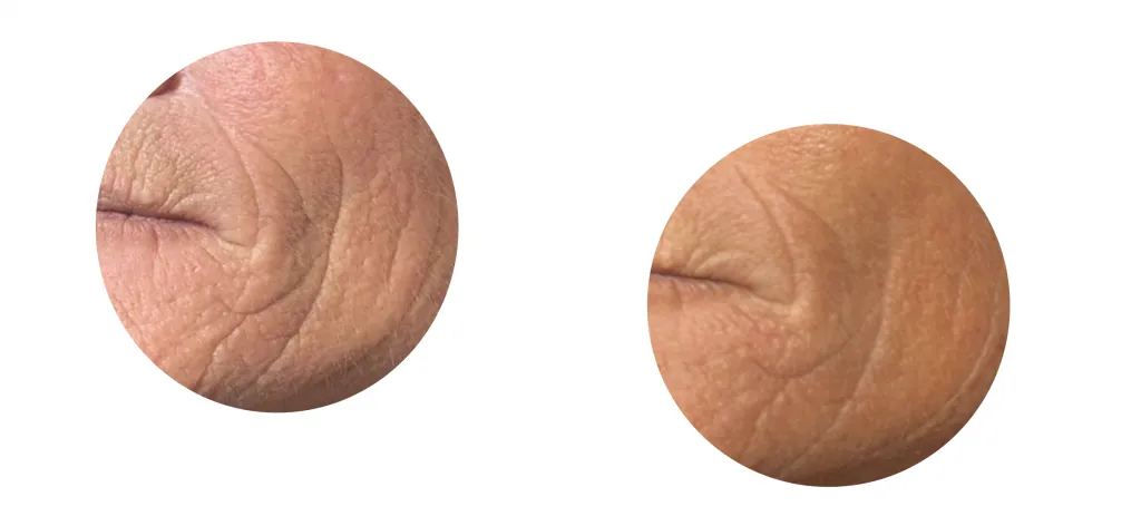 Resultaat micro needling