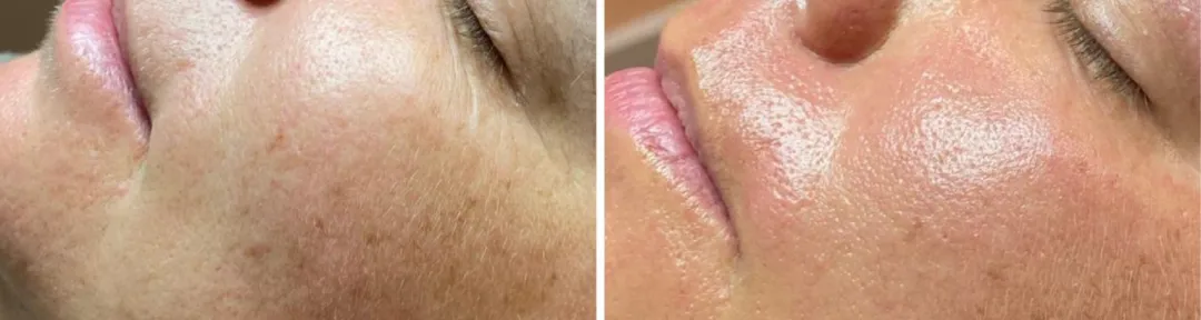 Peeling resultaten