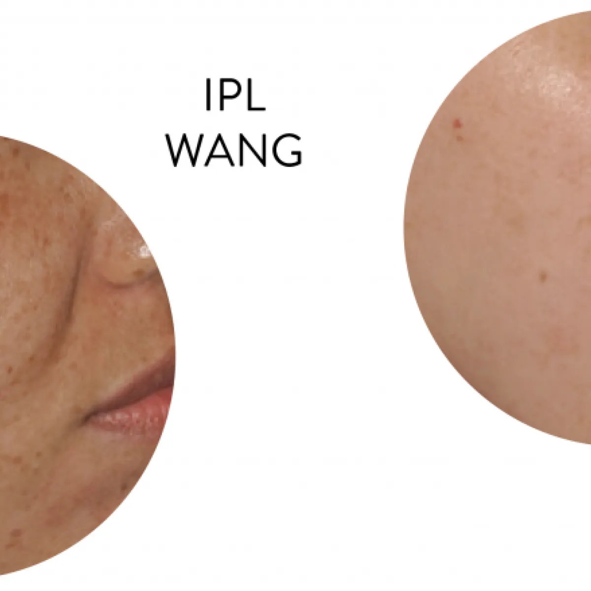 Pigmentvlekken verwijderen (IPL)