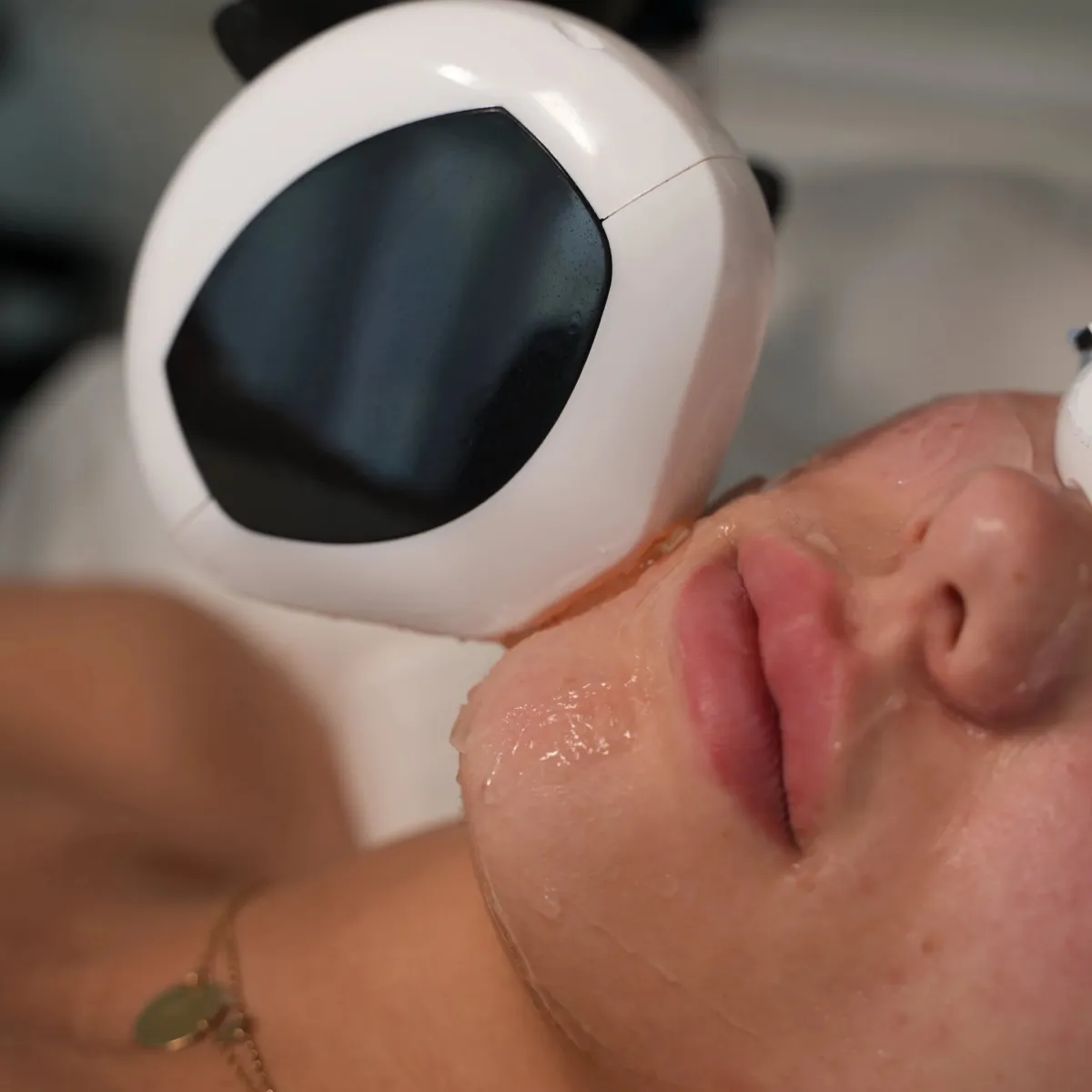 Couperose behandeling (IPL)